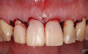 無痛の歯周病治療
